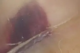 指甲出现黑线、竖纹是病吗？3种易被忽视的甲疾患，小心这种会癌变！图片