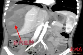 玩滑板车嬉戏追赶 男孩摔伤致肝脏破裂图片