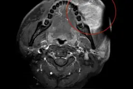 颊癌治疗不再是切除半边脸，新疗法兼顾患者健康与尊严图片