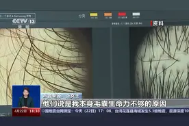 存活率成谜、维权难 植发为何成了“赌局”？图片