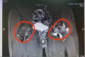 大量饮酒6年，小伙患上双侧股骨头坏死图片