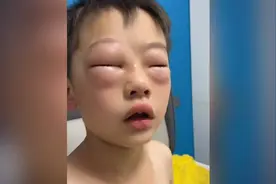 儿子不情愿写作业揉眼半小时，双眼水肿，妈妈：滴了眼药水，不让写作业就好了视频封面