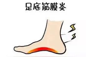筋膜炎的临床表现图片