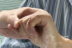 小指“罢工”五个月！小关节置换术重启手指活力图片