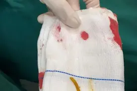 又是这根刺！我们问了医生，这个地方的刺，误吞的人最多！图片