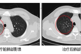 持续高热、头痛、全身酸痛，江苏确诊一例罕见传染病图片
