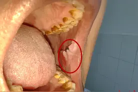 口腔白斑溃疡长期不愈，要警惕口腔癌图片