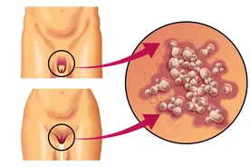 果然是阳性！小水疱长在那部位，又痒又痛...图片