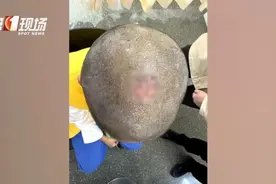 8岁男孩突然秃头！“元凶”竟然是……图片