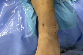 微创韧带修复重建术助力体育特长生重燃运动梦图片