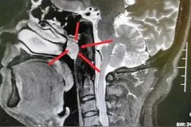 男子耳朵堵闷竟确诊鼻咽癌！医生：早期症状与鼻炎、中耳炎类似图片