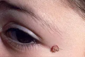 皮肤长这种小肉揪不能抠，会传染！图片