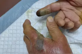 杭州男子被毒蛇咬伤！忍痛去抓，又来一口！卫健委紧急提醒：进入高峰期，保命方法必须记住图片