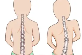 科学纠正青少年脊柱侧弯，市一康复科医生提醒你关注这些事丨健康智慧屋图片