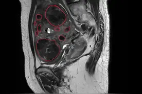 绝经女子腹痛难忍，竟因子宫“暗藏”42枚肌瘤！医生提醒：定期妇科检查不可少图片