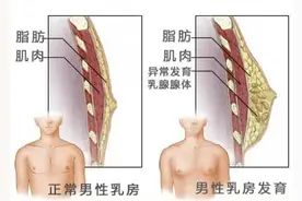 焦虑：男生青春期乳腺发育？图片