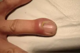 10个月婴儿被拔倒刺致心肺功能衰竭，这两种常见的拔倒刺方法可能危及生命图片