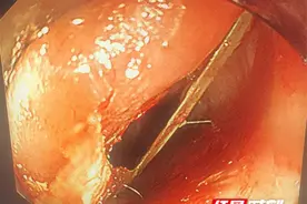 卓越医疗丨永州市中心医院：内镜精准出击 化解鱼刺危机图片