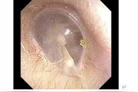 科普｜儿童肺炎支原体感染合并中耳炎，如何识别与应对？图片