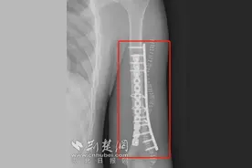 高三学生课间“较劲儿”竟掰断手臂 医生紧急手术成功解除“学业危机”图片