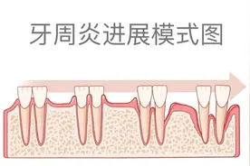 33岁“韦神”掉牙引热议，牙周炎危害大，这“三个一”你做对了吗？｜第医线图片