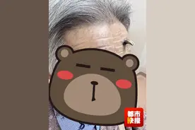 罕见！西安九旬老太额头上竟长出“犄角”……图片
