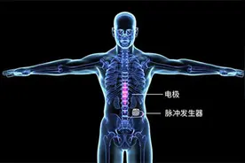 糖尿病痛性神经病变患者如何解除疼痛？湘雅二医院成功开展脊髓电刺激器植入术图片