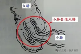 小儿肠套叠怎么办？图片