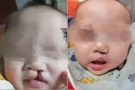 免费救治近400名唇腭裂患者，深圳微笑行动十年爱心坚守图片