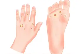 长瘊子了，可以不管它吗？图片