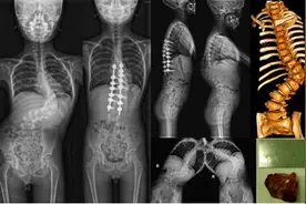 罕见！少年先天“剃刀背”，历时5年“掰直”!图片