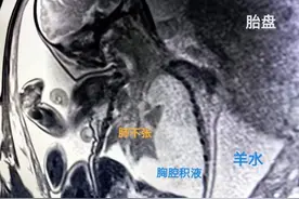 在“微小身体”里“极限”操作！仁济医院与儿中心接力救治胸腔积液胎儿图片
