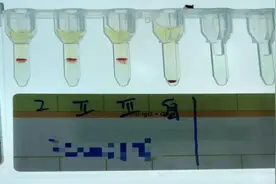 全球罕见！比“熊猫血”还稀有 云南文山首次发现人类罕见小p血型图片