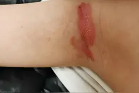 儿童“牛皮癣”不少见，但也不“牛皮”图片