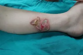 3岁男孩玩502胶水被烧伤 医生：502胶水化学反应瞬间可达90℃图片