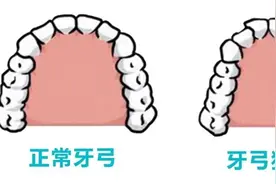 走出迷“弓”，什么是上牙弓狭窄？丨贤医健康说图片