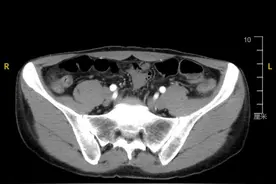 反复口腔溃疡、易腹痛腹泻，这个病竟可“祸及”全身图片