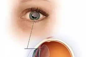 专家提醒：这种眼病千万别大意！图片