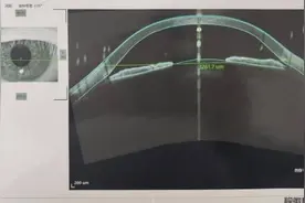 烟台首例！量身定制“大号硬性隐形眼镜”，圆锥角膜患者新选择！图片