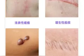 瘢痕？还是瘢痕疙瘩？皮肤科医生教您这样科学治疗！图片