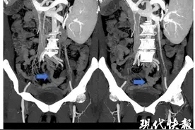女子特殊痔疮大出血，每次出血量达2000毫升险送命图片