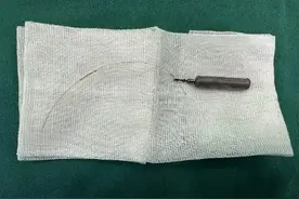 夜钓有风险！“老钓友”遭铅坠打入眼眶险失明图片