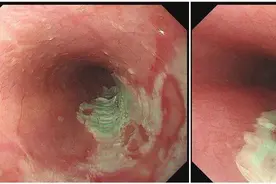 男子吃药只喝一口水致食管被“腐蚀”，正确服药有哪些讲究？图片