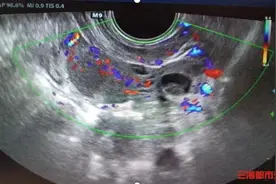 跳绳奔跑后肚子疼，11岁女孩输卵管扭转1800度图片