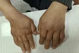 为什么痛风不能被彻底根治？图片