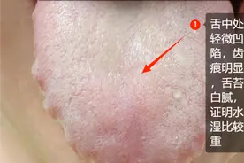 齿痕舌在脾，在肝 也在阳气，1个中成药，养脾调肝补阳 赶走齿痕舌图片