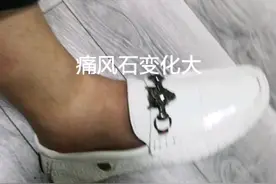 痛风石内服外敷中药几天，变软了