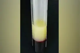 血管里流“牛奶”？西安29岁小伙患怪病，医生：吃出来的病视频封面