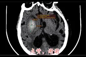 脑出血保守治疗后，CT平扫复查-体现治疗效果的方面有哪些？