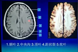 大脑半球分几个叶？额叶和顶叶如何区分？医生详细给您解答视频封面